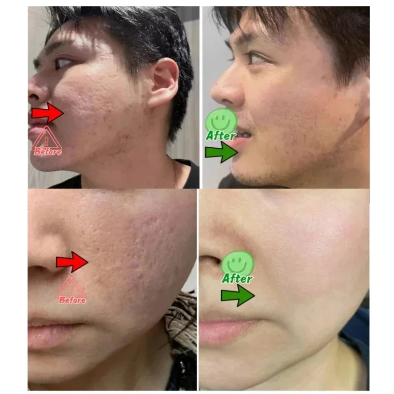Salicylic Acid Pore Clearing C - Salicylic Acid Blackhead Remover ulasan dan harga