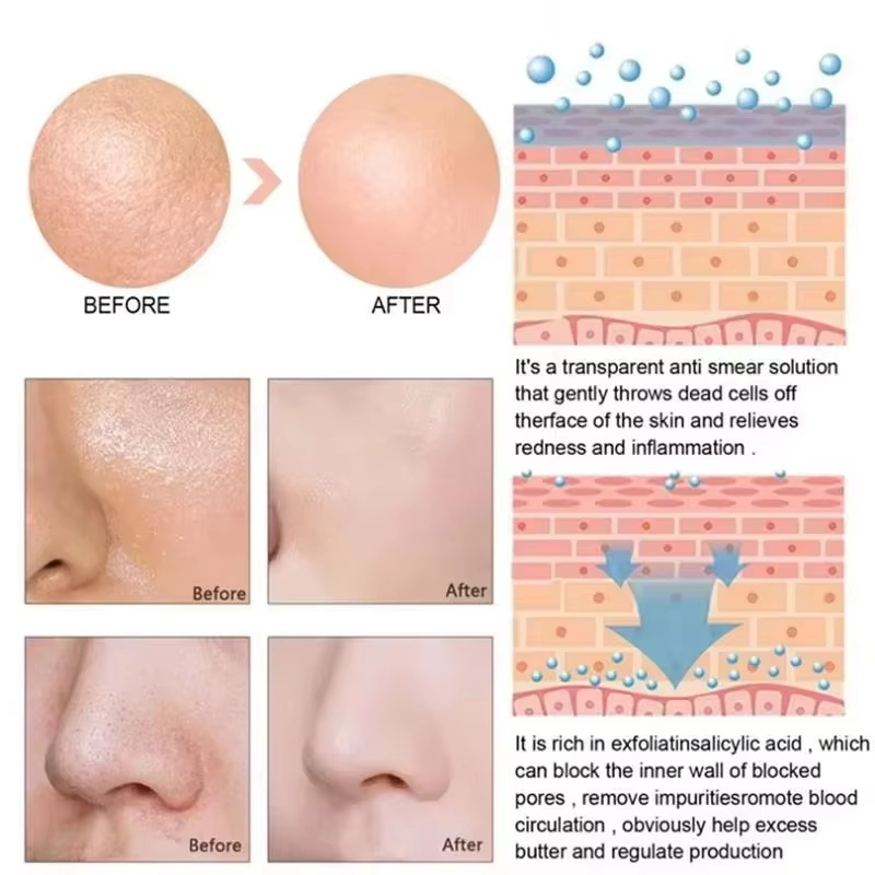 Salicylic Acid Pore Shrinking  - Salicylic Acid Blackhead Remover ulasan dan harga